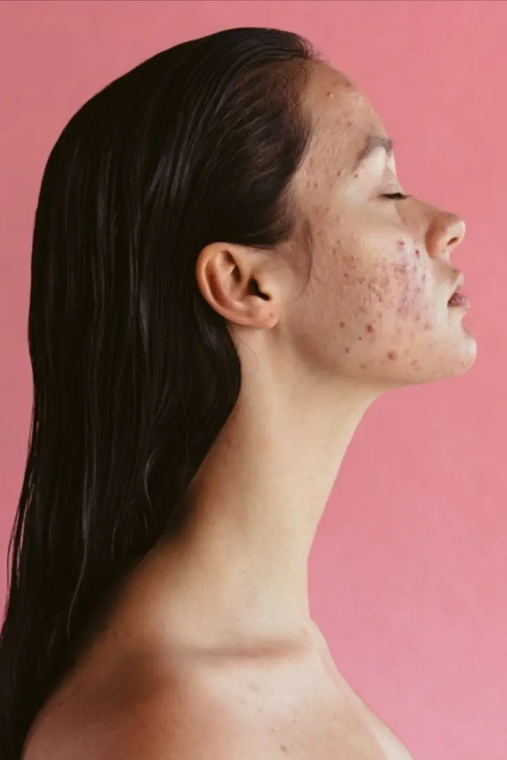 How to Stop Acne on Your Face: What Works and What to Avoid