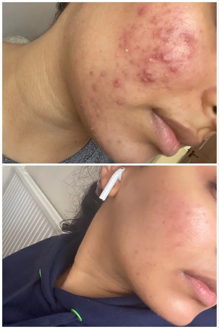 Banish Those Breakouts: Your Gen Z Guide to Conquering Adult Acne Like a Pro