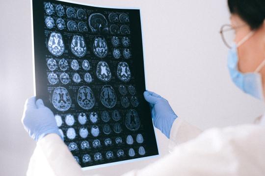 CagriSema May Quiet 'Food Noise,' Brain Scans Show at EASD 2026