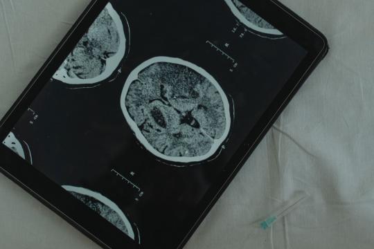 CagriSema Quiets Food Noise in New Brain Scan Study