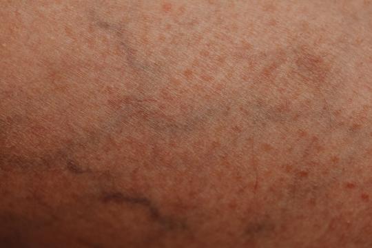 Climate Change Skin Disease Study Flags a Global Health Crisis